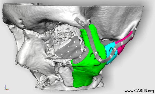 Reconstructie 3D-geprint